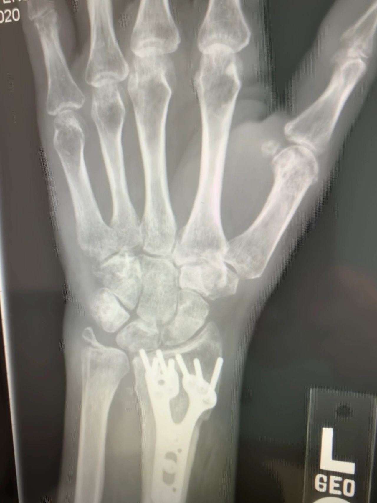 Left Wrist with hardware