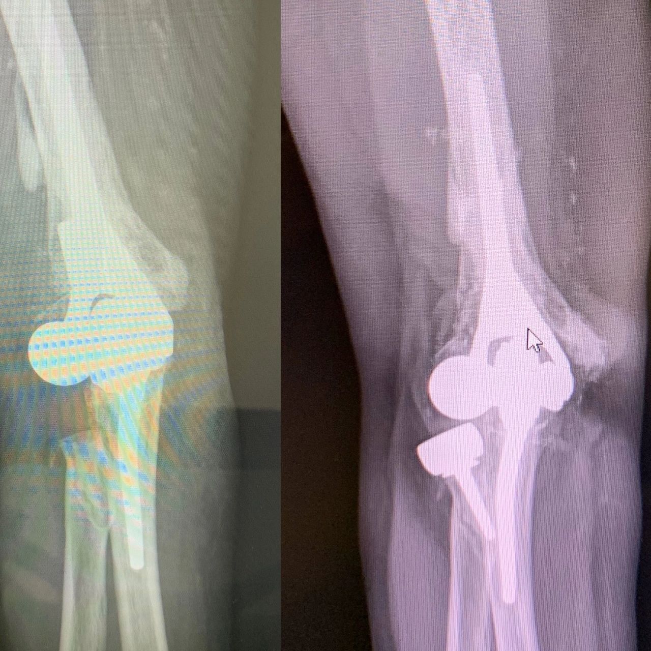 Right elbow Before and after revised surgery X-ray 
