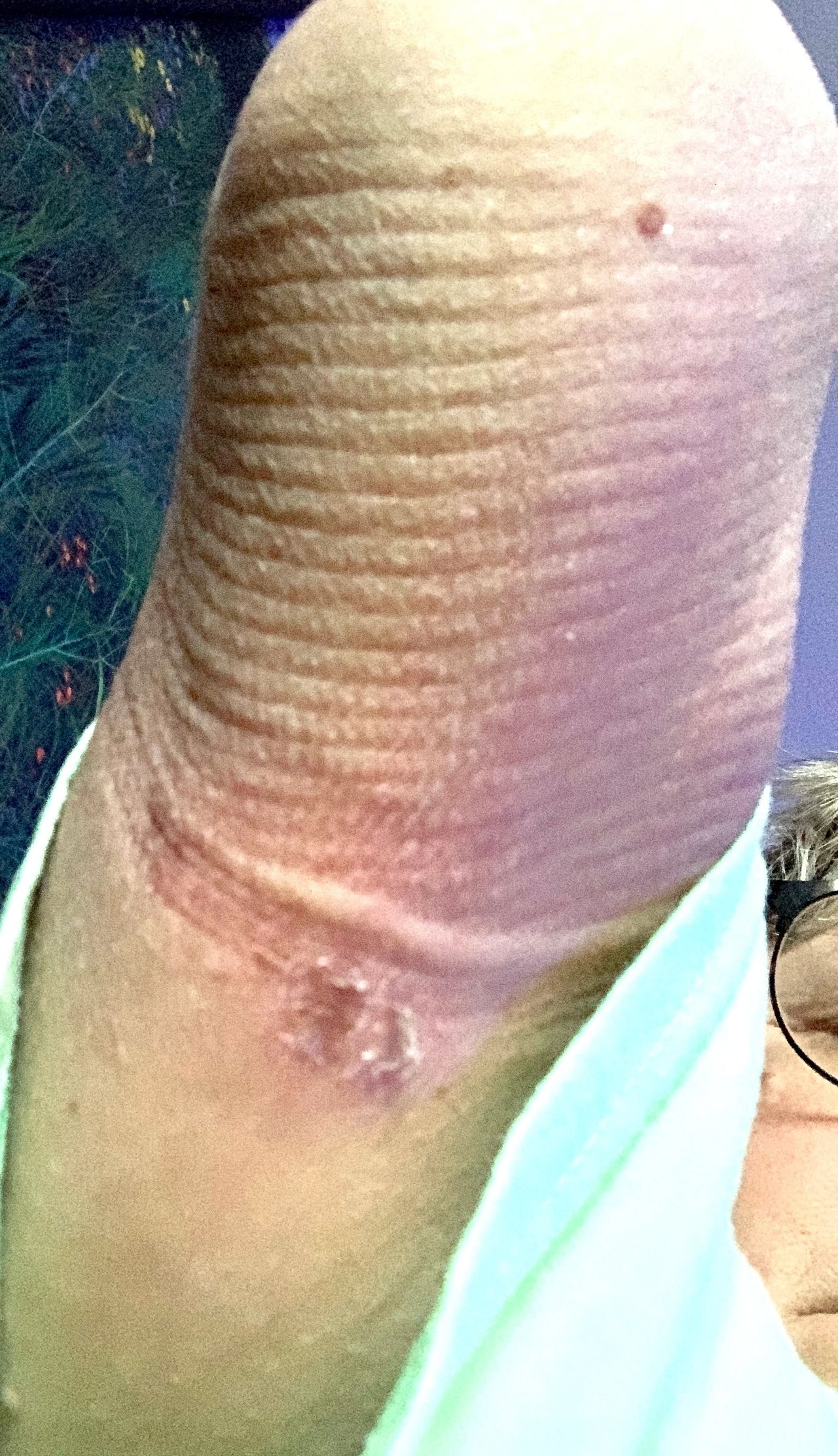 Sores from sock